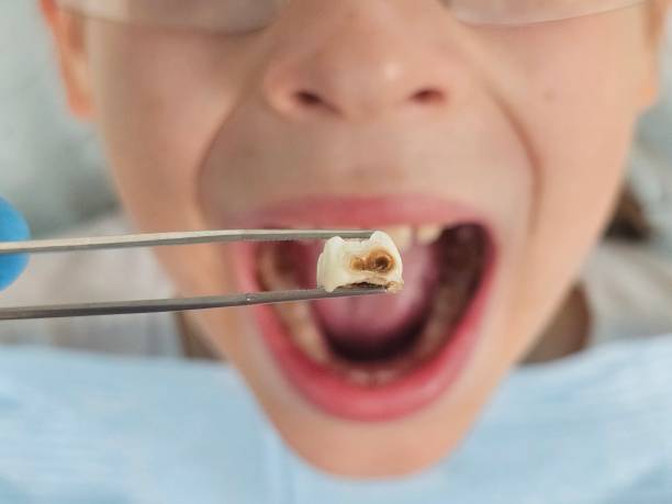 Best Emergency Wisdom Teeth Removal in Auburn Lake Trails, CA